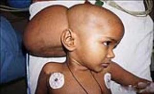 4گوشه دنیا/ تومور ۳ کیلویی در سر یک دختر هندی!