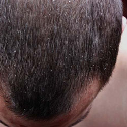 پوست و مو/ عوارض جانبی شوره سر