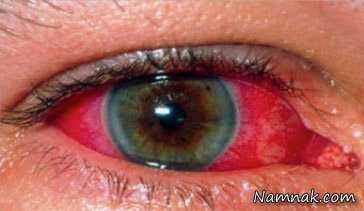 بیماری یوئیت چشم و راه های درمان آن ، بیماری یوئیت چشم ، علائم یوئیت چشم