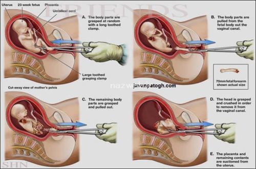 عکس های دردناک مراحل سقط جنین