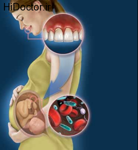gum-disease-affecting-unborn-baby