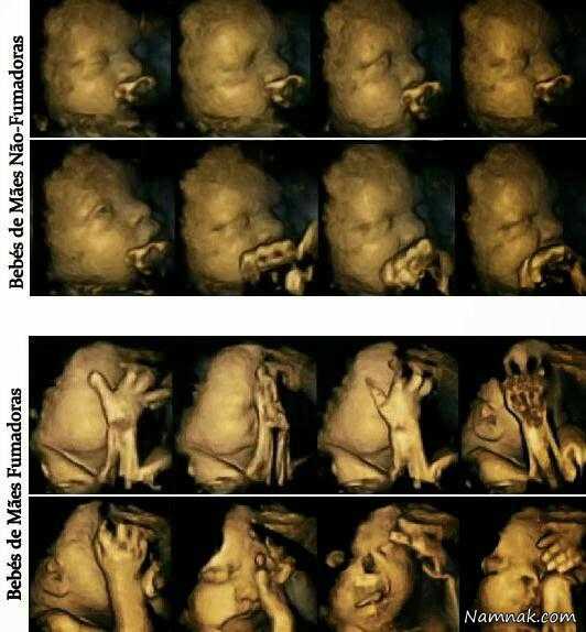 تصاویر وحشتناک از اثرات سیگار بر جنین ، سیستم عصبی جنین ، زنان باردار سیگاری