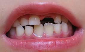 کودک/چگونه از دندان های شیری کودکمان محافظت کنیم؟