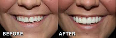 دهان و دندان/ روش درمان دندان های فاصله دار