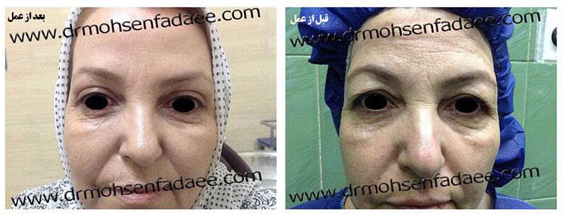 برترین نکات جراحی پلاستیک بینی و صورت - دکتر محسن فدایی