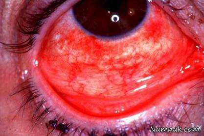 چشم قرمز ، قرمز شدن چشم ، عفونت چشم