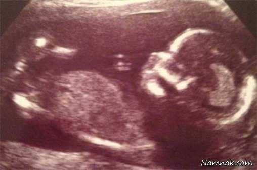 سونوگرافی زن باردار ، زن باردار ، اردک در شکم زن باردار