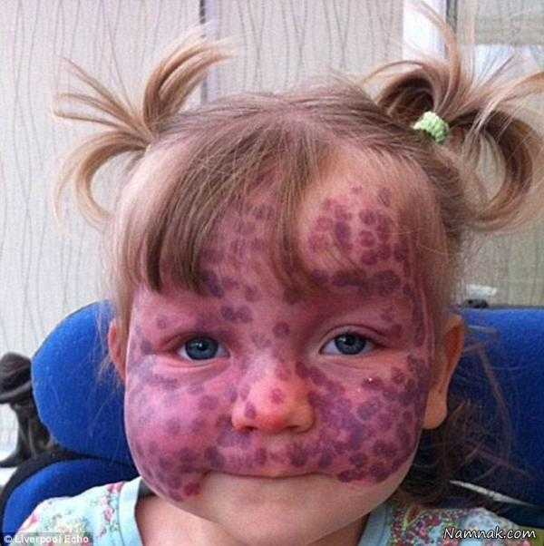  دختر بچه ای با خال های بنفش ، عجیب ترین بیماری های دنیا ، تصاویر بیماریهای عجیب