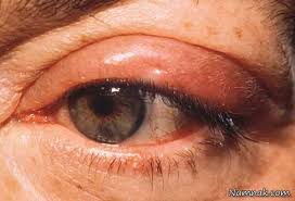 دکتر سلام/ قطره های چشمی گاهی سبب بروز آب سیاه می شوند