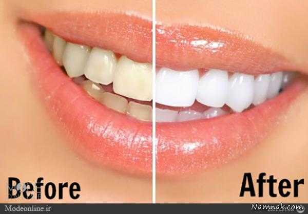 روش سفید کردن دندان  ، سفید شدن سریع دندان ، راههای سفید كردن دندانها
