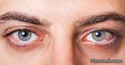 یوئیت چشم چیست؟ علائم و راه درمان بیماری یووئیت ، علائم یوئیت چشم ، انواع یووئیت چشم