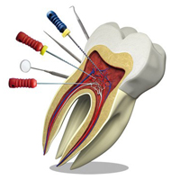 دهان و دندان/ درمان ریشه یا کشیدن دندان؟