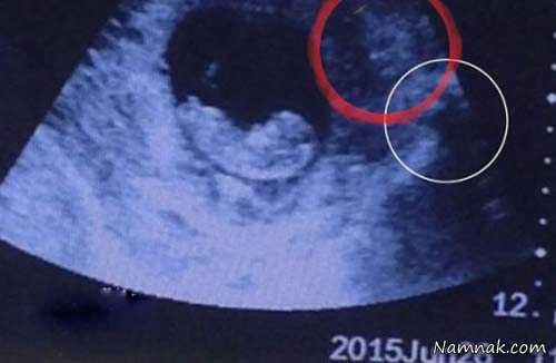 شیطان داخل شکم زن باردار ، عکس سونوگرافی جنین ، سونوگرافی عجیب