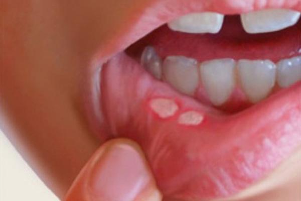 دهان و دندان/ موثرترین درمان آفت ، بدون دارو