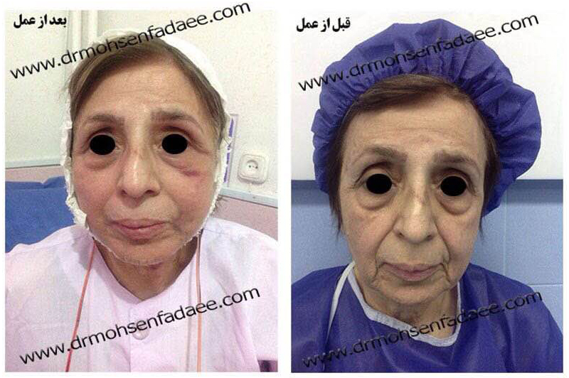 برترین نکات جراحی پلاستیک بینی و صورت - دکتر محسن فدایی