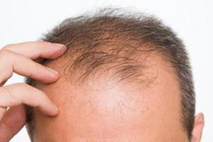 پوست و مو/چرا موهای مردان بیشتر میریزد؟