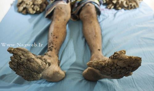 18+ عکس های تکان دهنده پسری با دردناک ترین بیماری دنیا