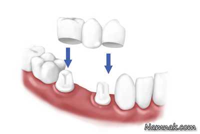 پروتز دندان ، پروتز دندان متحرک ، پروتز دندان چیست