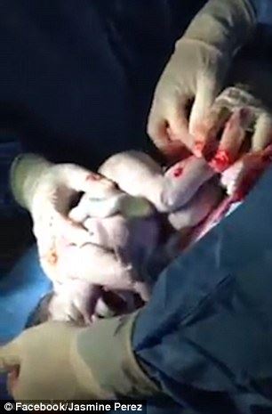 نوزادی که با تولد حیرت انگیز پزشکان را به چالش کشید! عکس