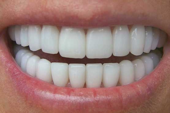 جرم گیری باور نکردنی دندان با یک محلول خانگی