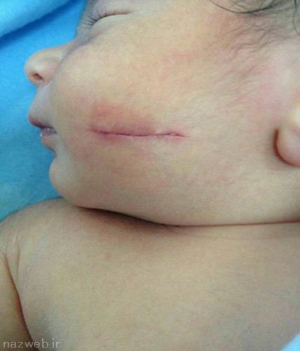 بریدن صورت نوزاد هنگام عمل سزارین (عکس)