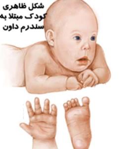 کودک/ بارداری در سن بالا عامل سندروم داون در نوزادان است