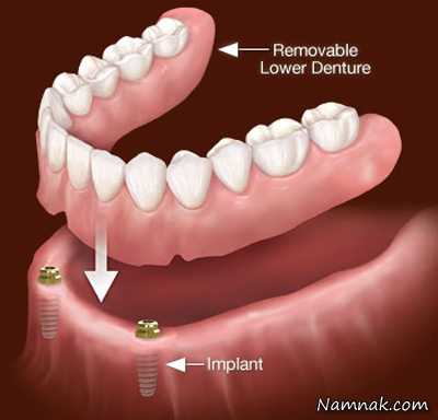 پروتز دندان ، پروتز دندان،انواع پروتز دندان ، پروتز ثابت دندان