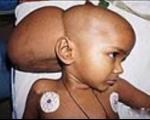 4گوشه دنیا/ تومور ۳ کیلویی در سر یک دختر هندی!