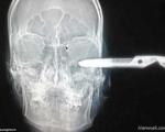 4گوشه دنیا/  جراحی خطرناک خارج کردن قیچی از سر یک مرد