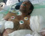 پیوند دست قطع شده کشاورز مازندرانی در بیمارستان امام(ره) ساری + عکس