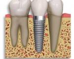 ایمپلنت و کاشت دندان در کدام افراد ممنوع است