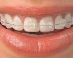 دهان و دندان/ همه چیز درباره ارتودنسی