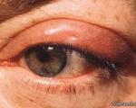 دکتر سلام/ قطره های چشمی گاهی سبب بروز آب سیاه می شوند
