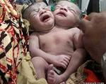 تولد نوزاد دو سر در بنگلادش + تصاویر