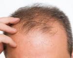 پوست و مو/چرا موهای مردان بیشتر میریزد؟