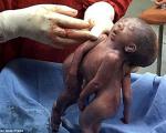 تولد نوزاد دوقلو با یک صورت + عکس18