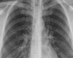 تشخیص بیماری با صدای تنفس به وسیله یک نرم افزار