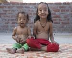 بیماری عجیب و غریب خواهر و برادر خردسال هندی +تصاویر