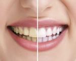 رفع زردی دندان با کمک فویل آلومینیومی - چگونه دندان های زرد را سفید کنیم؟ -آکا