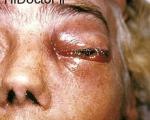 موکور میکوزیس (بیماری ناشی از عفونت خارجی) Mucormycosis