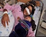 جزئیات بریدن بینی زن افغان به دست همسرش + عکس