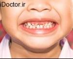عوامل مرتبط با از بین رفتن دندان های شیری