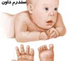 کودک/ بارداری در سن بالا عامل سندروم داون در نوزادان است